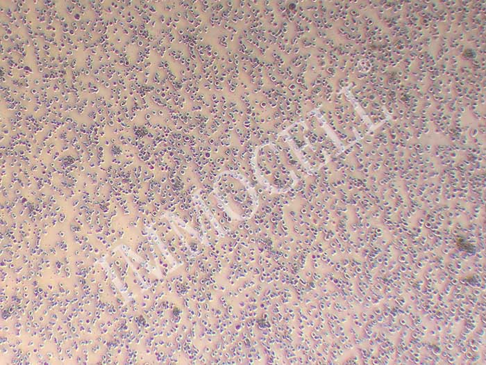 人T淋巴瘤白血病细胞图片